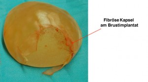 fibröse Kapsel  am Brustimplantat