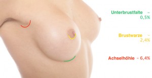 Einfluss der Schnittstelle auf die Entwicklung der fibrösen Kapsel an Brustimplantaten
